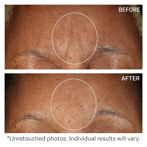 StriVectin SD Advanced Plus Intensive Moisturizing Concentrate for Wrinkles and Stretchmarks, Reduces Look of Deep Wrinkles and Stretchmarks